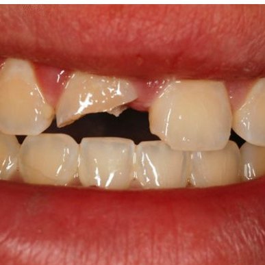 Dente da frente quebrado com parte da coroa faltando